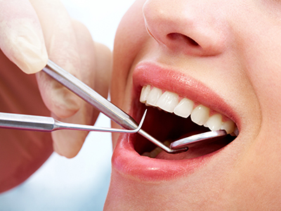 虫歯の進行段階と治療方法