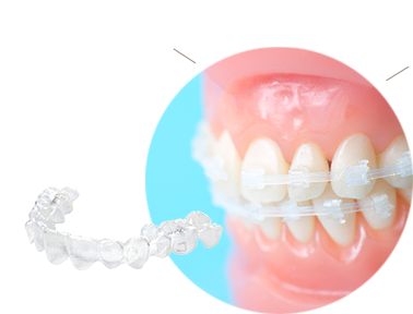 目立たない矯正が人気です！