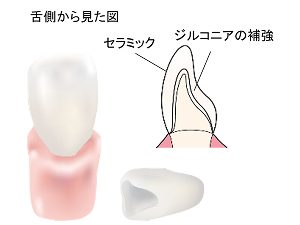 ジルコニアセラミック
