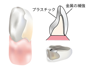 硬質レジン（前装／保険適応）