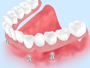 インプラントオーバーデンチャー