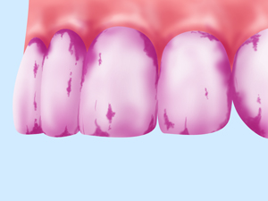 歯垢の染め出し(みがき残しチェック)