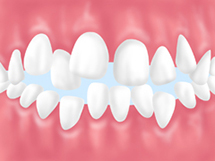 叢生（そうせい）「デコボコの歯並び」