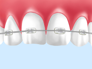 ブラケット矯正