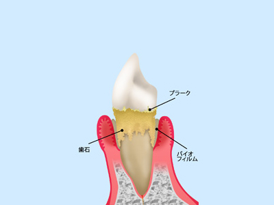歯周病って何？