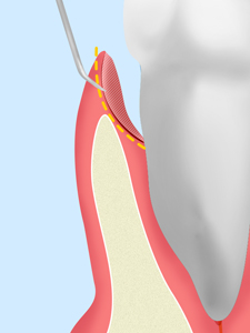 歯周ポケットそうは術 2