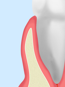 歯周ポケットそうは術 3